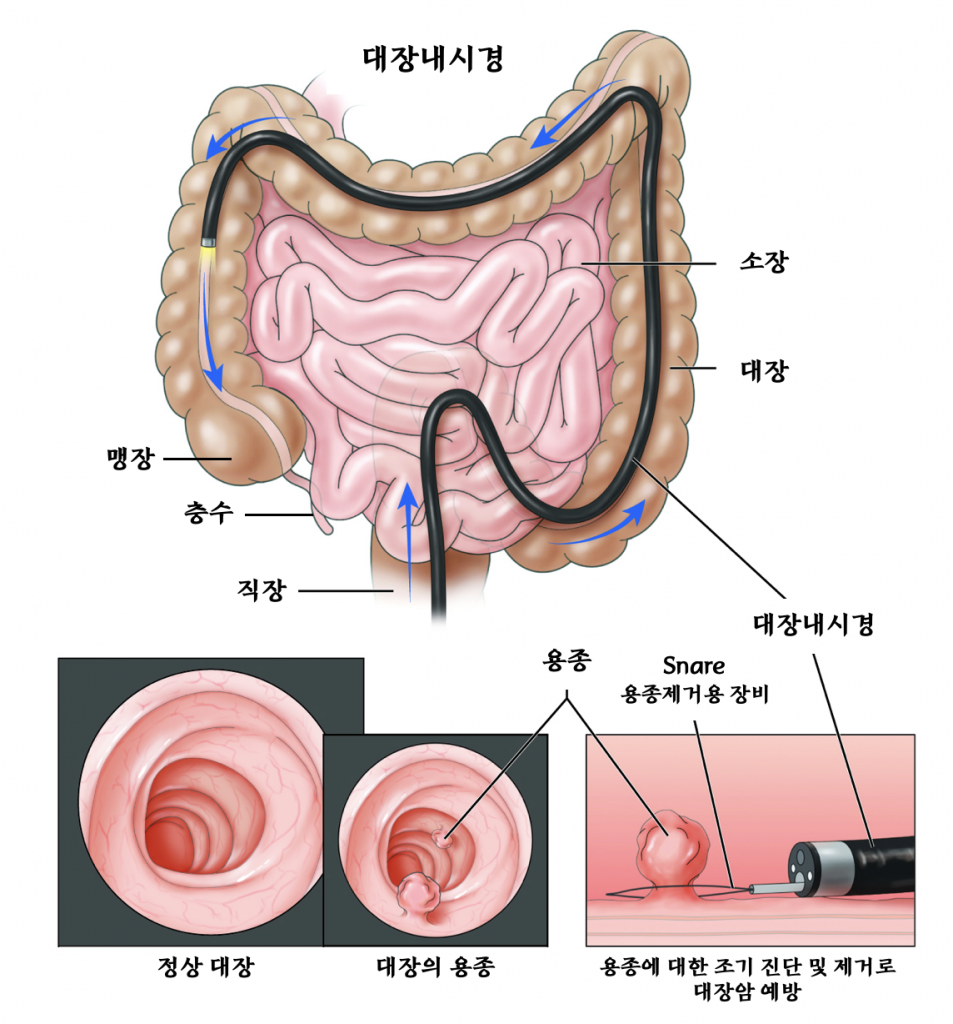 대장내시경